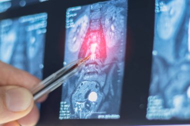 Omurgadaki fıtıklaşmış omurilik diskinin MRI 'sı incelensin..