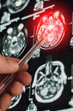 İnsan beyninin dikey tomografi görüntüsü. Tanısal insan kafa hastalıkları için MRI veya X-ray taraması.