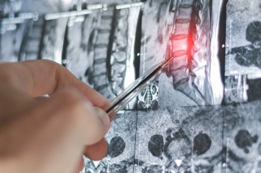 İnsan omurgasında bel ve göğüs fıtığı röntgeni. Hastalıkların MR 'ı.