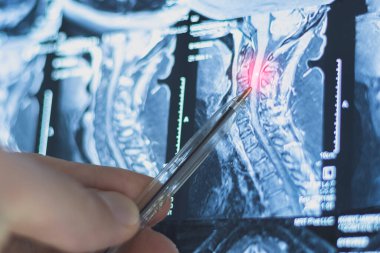 İnsan omurgasında bel ve göğüs fıtığı röntgeni. Hastalıkların MR 'ı.