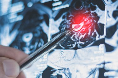 İnsan omurgasında bel ve göğüs fıtığı röntgeni. Hastalıkların MR 'ı.