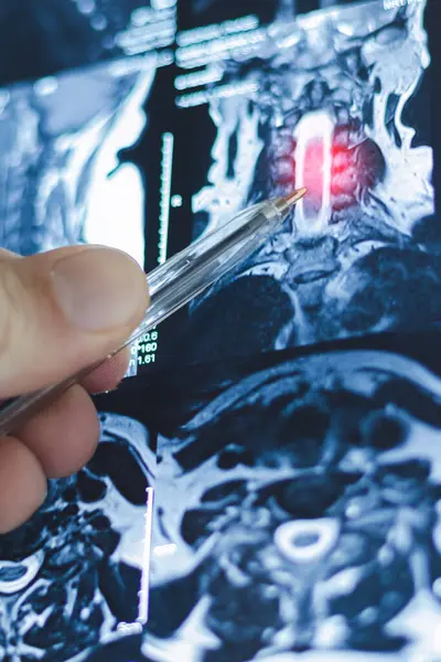 İnsan omurgasında dikey bel ve göğüs fıtığı röntgeni. Hastalıkların MR 'ı.