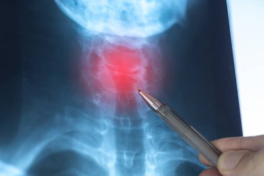 Doctor learning X-ray scan with displacement of intervertebral discs and herniation in the cervical spine.