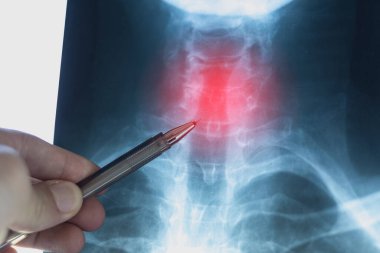 Doctor learning X-ray scan with displacement of intervertebral discs and herniation in the cervical spine.