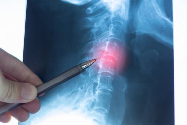 Doctor learning side X-ray scan with displacement of intervertebral discs and herniation in the cervical spine.