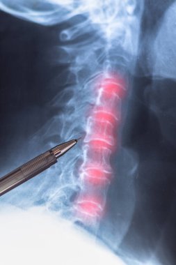 Doktor dikey röntgen taraması öğreniyor. Omurgalar arası diskler yerinden oynamış ve boyun omurunda fıtık oluşmuş..