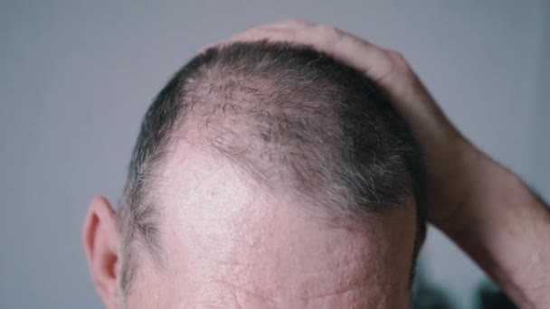 脱毛の問題を持つ高齢者は手で彼の脱毛灰色の頭に触れます 大胆さ 頭の一部 髪の毛を指で動かす 正面図 高齢者 成熟した男性の脱毛症 灰色の背景 — ストック動画
