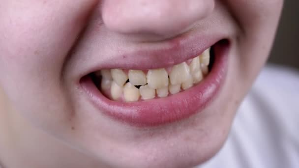 Zblízka Široký Úsměv Teenagera Rovnými Sudými Zuby Plaketou Části Těla — Stock video