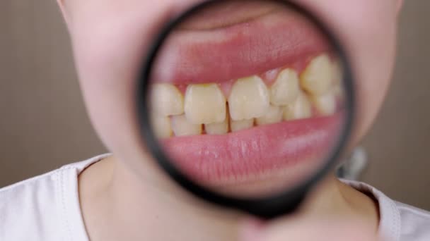 拡大鏡を通して歯科用プレートで広い歯の笑顔を示す少年 顔を閉じて唇を 体の部分 肖像画 口腔衛生の概念 ズーム 青灰色の背景 口腔ケア — ストック動画