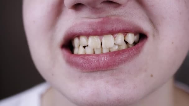Großaufnahme Breites Lächeln Eines Teenagers Mit Geraden Sogar Zähnen Und — Stockvideo