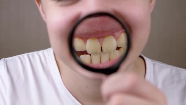 Chłopiec Pokazuje Szeroki Uśmiech Blachy Dentystycznej Przez Szkło Powiększające Zamknij — Wideo stockowe
