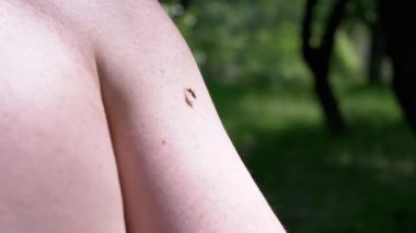 Ormanda Sivrisinek Eline Kan İçen Doğanın Bulanık Geçmişinde. Kapatın. Böcek kanı emici. Vücut parçası. Gnat kan emer. Enfeksiyon, beyin iltihabı, ateş, virüs sıtması. Huzur içinde yat..