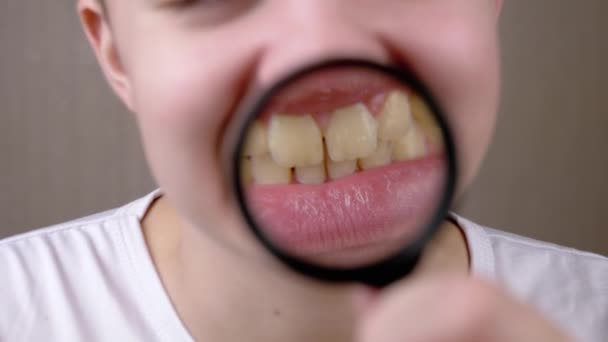 Boy Showing Wide Toothy Smile Dental Plaque Magnifying Glass Fecha — Vídeo de Stock
