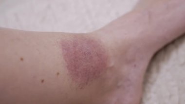 Yaklaş, Kene ısırığından deride büyük kırmızı bir leke oluşumu. Kızarıklık, kaşıntı, şişlik, enfeksiyon, bacak çevresinde kızarıklık. Lyme hastalığı. Böcek, sivrisinek, beyin iltihabı kene ısırığı.