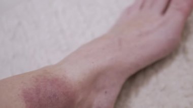 Yaklaş, Kene ısırığından deride büyük kırmızı bir leke oluşumu. Kızarıklık, kaşıntı, şişlik, enfeksiyon, bacak çevresinde kızarıklık. Lyme hastalığı. Böcek, sivrisinek, beyin iltihabı kene ısırığı.