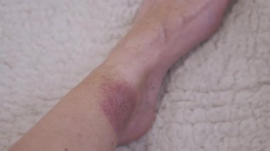 Yaklaş, Kene ısırığından deride büyük kırmızı bir leke oluşumu. Kızarıklık, kaşıntı, şişlik, enfeksiyon, bacak çevresinde kızarıklık. Lyme hastalığı. Böcek, sivrisinek, beyin iltihabı kene ısırığı.