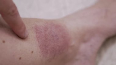 Yaklaş, Kene ısırığından deride büyük kırmızı bir leke oluşumu. Kızarıklık, kaşıntı, şişlik, enfeksiyon, bacak çevresinde kızarıklık. Lyme hastalığı. Böcek, sivrisinek, beyin iltihabı kene ısırığı.