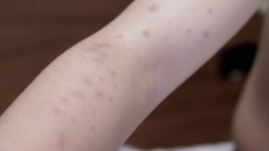 İnsan kolundaki deri alerjisi kızarıklığını kapat. Kızarıklıklar deride küçük, kırmızı şişlikler olarak görünüyor..