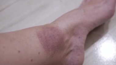 Yaklaş, Kene ısırığından deride büyük kırmızı bir leke oluşumu. Kızarıklık, kaşıntı, şişlik, enfeksiyon, bacak çevresinde kızarıklık. Lyme hastalığı. Böcek, sivrisinek, beyin iltihabı kene ısırığı.