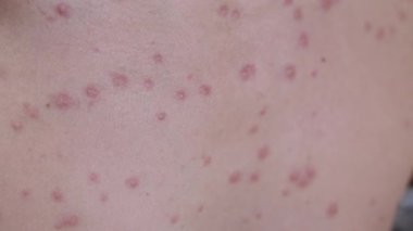 Suçiçeğinin bir insanın göğsündeki kızarıklığının detaylı görüntüsü. Kırmızı noktalar ve kabarcıklar, biraz da kabuk. Sağlık, cilt bakımı, bulaşıcı hastalık konsepti..