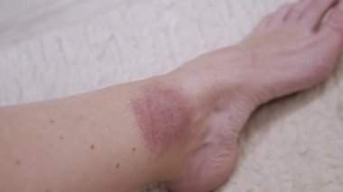 Yaklaş, Kene ısırığından deride büyük kırmızı bir leke oluşumu. Kızarıklık, kaşıntı, şişlik, enfeksiyon, bacak çevresinde kızarıklık. Lyme hastalığı. Böcek, sivrisinek, beyin iltihabı kene ısırığı.