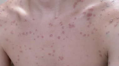 Ciltte suçiçeği kabarcıklarının yakın çekimi. Viral hastalık kavramı, dermatolojik hastalıkların tedavisi ve cilt sorunları.