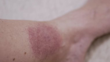 Yaklaş, Kene ısırığından deride büyük kırmızı bir leke oluşumu. Kızarıklık, kaşıntı, şişlik, enfeksiyon, bacak çevresinde kızarıklık. Lyme hastalığı. Böcek, sivrisinek, beyin iltihabı kene ısırığı.