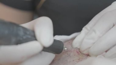 Dermatolog hastaya saç nakli yapıyor. Yakın çekim kellik tedavisi, Dhi metoduyla saç nakli.