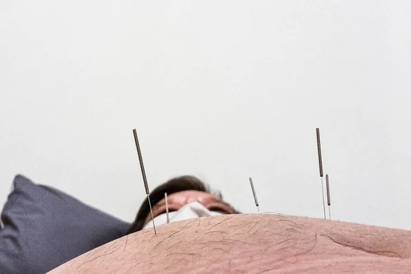 Apropierea Unui Bărbat Asiatic Care Primește Tratament Acupunctură Burta Mare — Fotografie, imagine de stoc