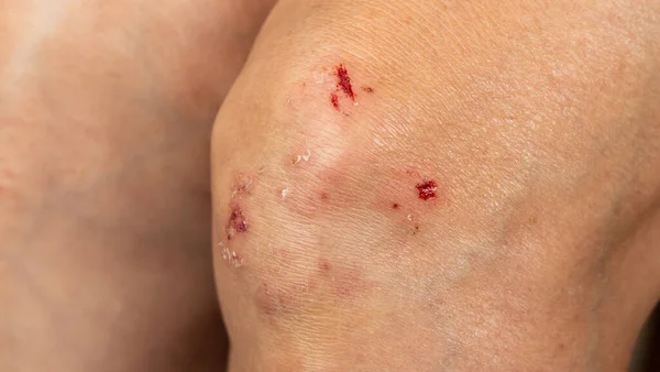 因意外而导致的伤口堵塞及膝伤及新鲜血液在亚洲腿伤的愈合 — 图库照片