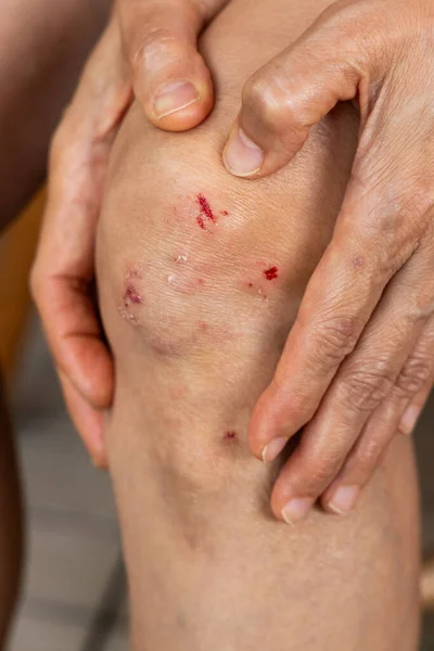 Vérző Kezeket Átölelő Kezek Sebet Ejtenek Ázsiai Térden Friss Vérrel — Stock Fotó