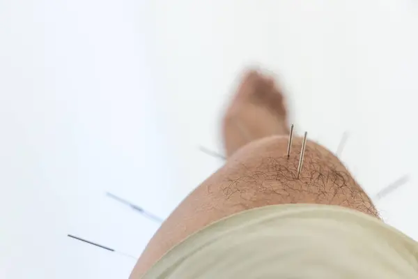 Closeup of acupuncture needles on thigh of Chinese man during acupuncture treatment at clinic