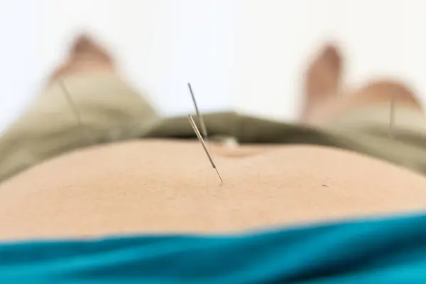 Closeup of acupuncture needles on belly of Chinese man during acupuncture treatment at clinic