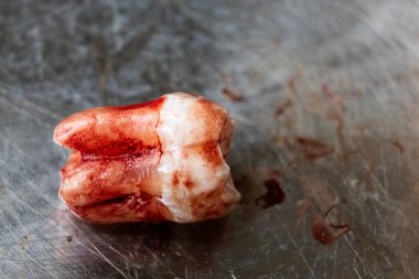Diş kliniğindeki paslanmaz çelik konteynıra odaklanmış kan lekeli yeni çıkarılmış azı dişi.