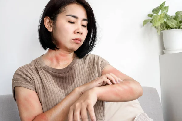 Азиатки Аллергия Собственную Потную Руку Царапающую Зудящую Сыпь Коже Жаркой — стоковое фото