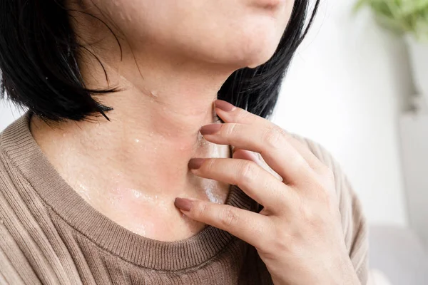Крупный План Женщина Рука Царапает Зуд Кожи Шее Вызванный Аллергией — стоковое фото