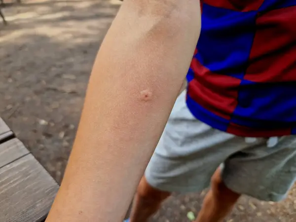 Stock image reaction to a wasp sting. the boy shows an incipient swelling and a pimple on his hand. allergy drops for anaphylactic shock. pain and tears accompany the bee incident