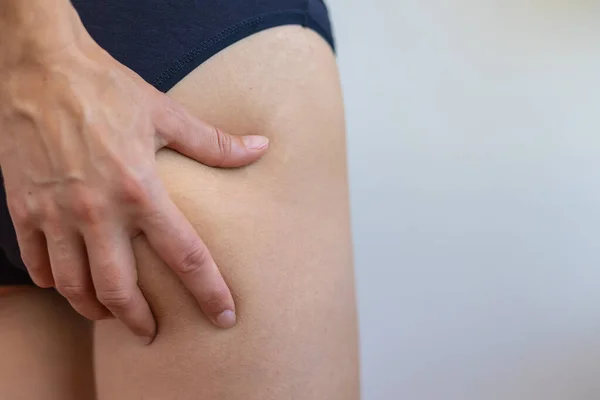 Stretch marks on female legs. A woman\'s hand holds a fat cellulite and a stretch mark on her leg. Cellulite