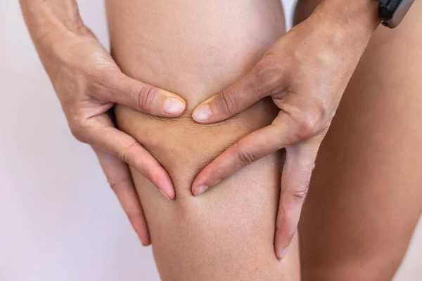 Stretch marks on female legs. A woman's hand holds a fat cellulite and a stretch mark on her leg. Cellulite