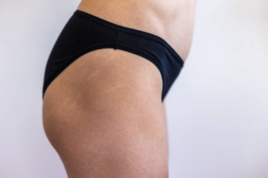 Kalçasında gerilme izleri olan kadın vücudu, kilo verdikten sonra cildinde gerilme izleri, doğum sonrası deri değişimi.