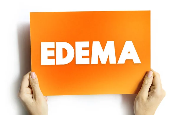 Edema是由于身体组织中的多余液体 卡片上用于演示和报告的文字概念而引起的肿胀 — 图库照片