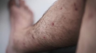 Yakın çekim bir adamın bacağında birden fazla kırmızı böcek ısırığı olduğunu gösteriyor. Video tahriş olmuş deriyi ve ısırıkların boyutunu vurguluyor..