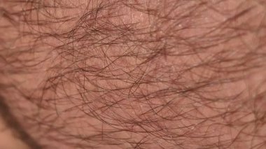 Aşırı yakın çekim makro çekim, foliküllerden büyüyen koyu saçlı insan derisinin detaylı dokusunu ortaya çıkarıyor. Yüzeyde gözenekler ve ince çizgiler var, biyolojik ve dermatolojik bir kavram..