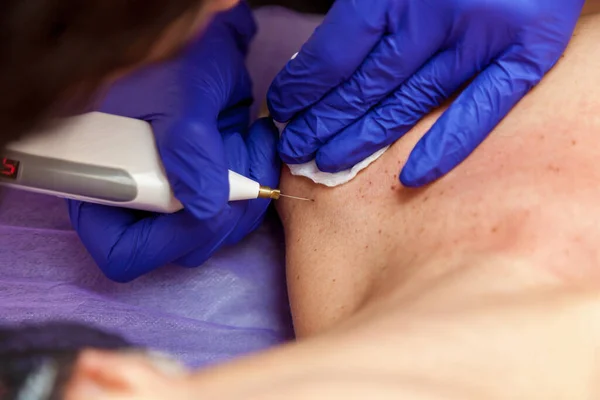 stock image A cosmetologist in blue gloves removes papillomas on a girl's body with an electrocoagulator, cauterizing them with a high-frequency current.