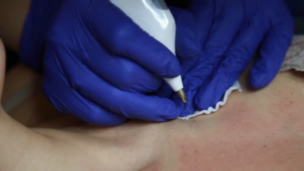Kosmetolog Modrých Rukavicích Odstraňuje Papilomy Dívčím Těle Elektrokoagulátorem Vypaluje Vysokofrekvenčním — Stock video