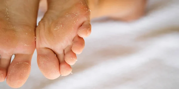 お風呂の後に皮を剥ぐ大人の女性の足を閉じます 損傷した真皮の剥離 皮膚や足のケアの概念 — ストック写真
