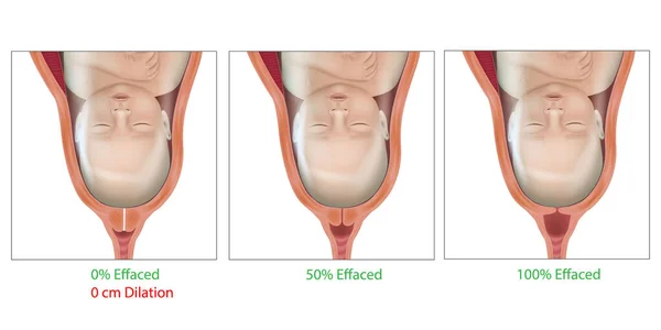 Efeito Cervical Dilatação Durante Parto Cervix Trabalho Parto Entrega Cervix — Vetor de Stock