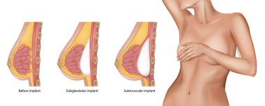 Subglandüler ve submusküler göğüs implantları. Kadın göğsünün estetik ameliyatı. İmplanttan önce ve sonra