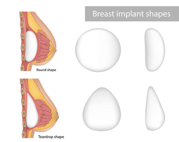 Breast implant shapes Teardrop shape and Round shape. cosmetic surgery. Bust enhancement result, woman chest after plastic surgery. Breast implant types.