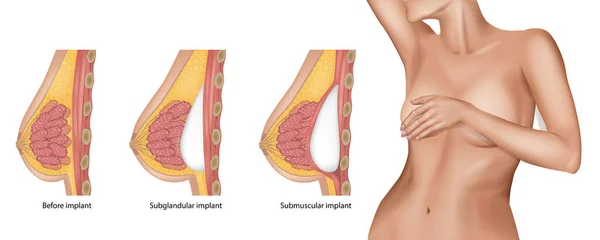 腺体下和肌肉下乳房植入 女性乳房整形手术 植入物植入前后 — 图库矢量图片
